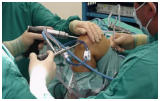 Artroscopía o Cirugía de Rodilla en Toluca