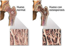 Tratamiento de osteoporosis en Toluca
