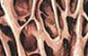 Tratamiento de Osteoporosis en Toluca