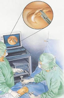 Cirugía Artroscópica de Rodilla en Toluca