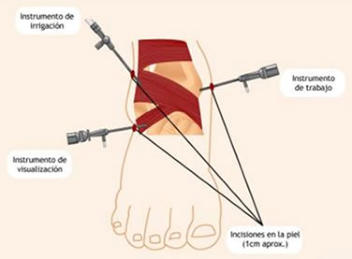 Cirugía Artroscópica de Tobillo en Toluca