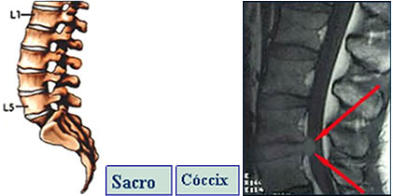 Cirugía de columna lumbar en Toluca