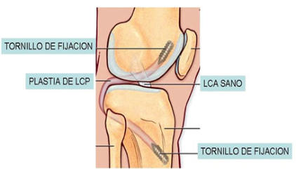 Cirugía del Ligamento Cruzado Posterior en Toluca