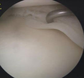 Cirugía de los Meniscos en Toluca