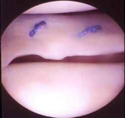 Sutura meniscal