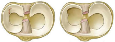 Cirugía de los Meniscos Toluca