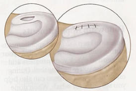 Rotura de los Meniscos