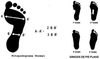 Tratamiento del Pie Plano