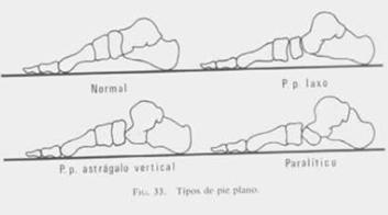 Tratamiento del Pie Plano Toluca