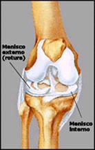 Tratamiento de Rotura de los Meniscos en Toluca